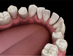 Illustration of gapped teeth