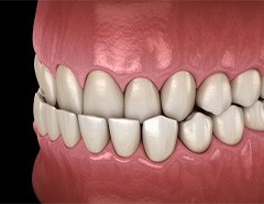 Illustration of underbite