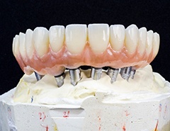  Example of Implanted dentures in Newark