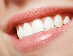 Smiling woman with porcelain veneers