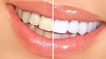 Sparkly smile that’s split in half to show the before/after results of teeth whitening